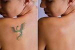 Tattoo Removal for Career Changes: A Growing Trend