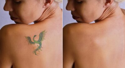 Tattoo Removal for Career Changes: A Growing Trend