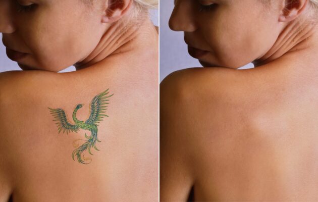 Tattoo Removal for Career Changes: A Growing Trend