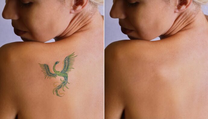Tattoo Removal for Career Changes: A Growing Trend