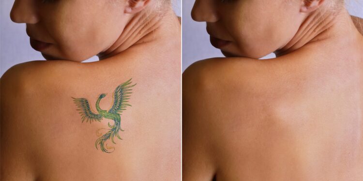 Tattoo Removal for Career Changes: A Growing Trend