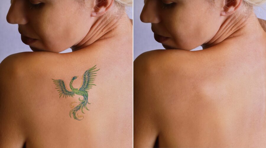 Tattoo Removal for Career Changes: A Growing Trend