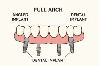 All-on-4 dental implants