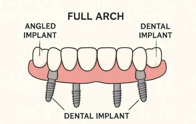All-on-4 dental implants