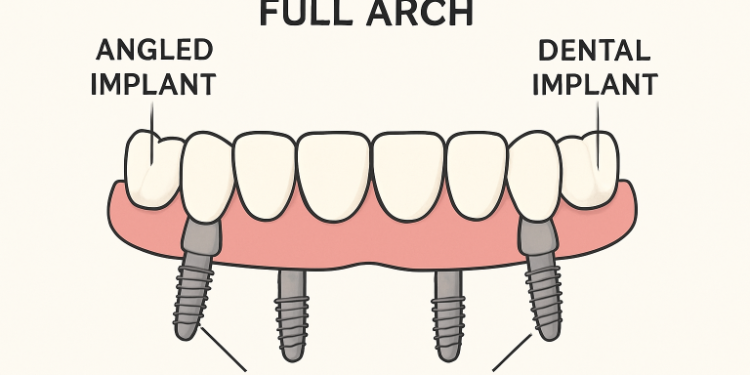 All-on-4 dental implants